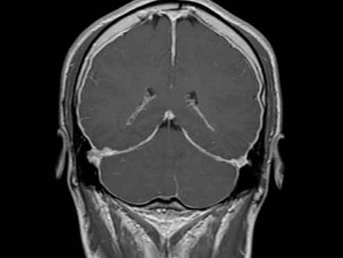 Sindrome da Ipotensione liquorale